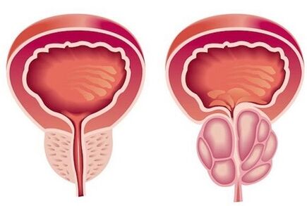 Sintomas de prostatite em homens